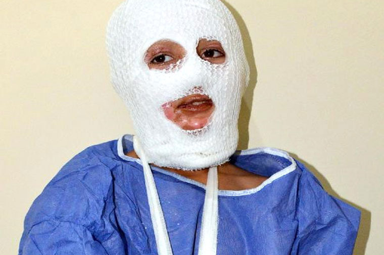 Zibilxanada partlayış: 11 yaşlı uşağın üzü yandı – Fotolar